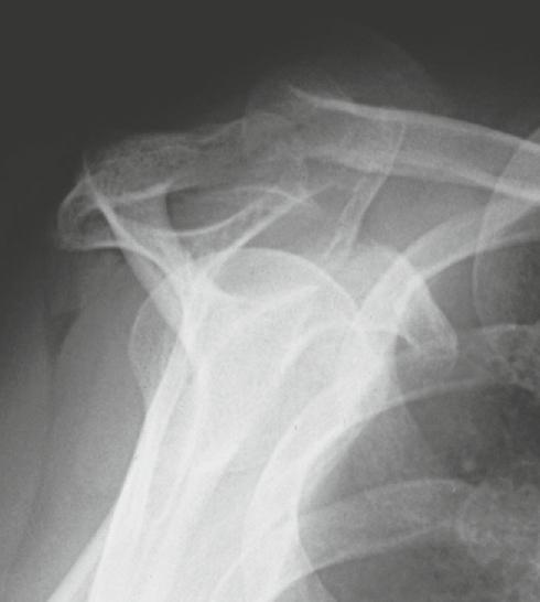 1 Schulter, Oberarm Subakromiale Knochenkonsole bei Impingement Befund: In der Outlet-View-Aufnahme ist eine subakromiale konkav begrenzte Knochenkonsole erkennbar, die sich von kranial der
