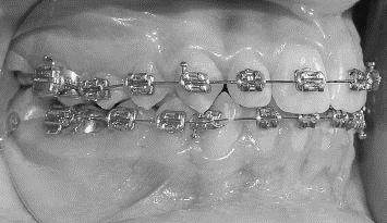 Unfall verloren ging. b) Wie wird der fehlende Zahn in der Fachsprache genannt? Aufgabe 43 Kieferorthopädische Apparaturen.