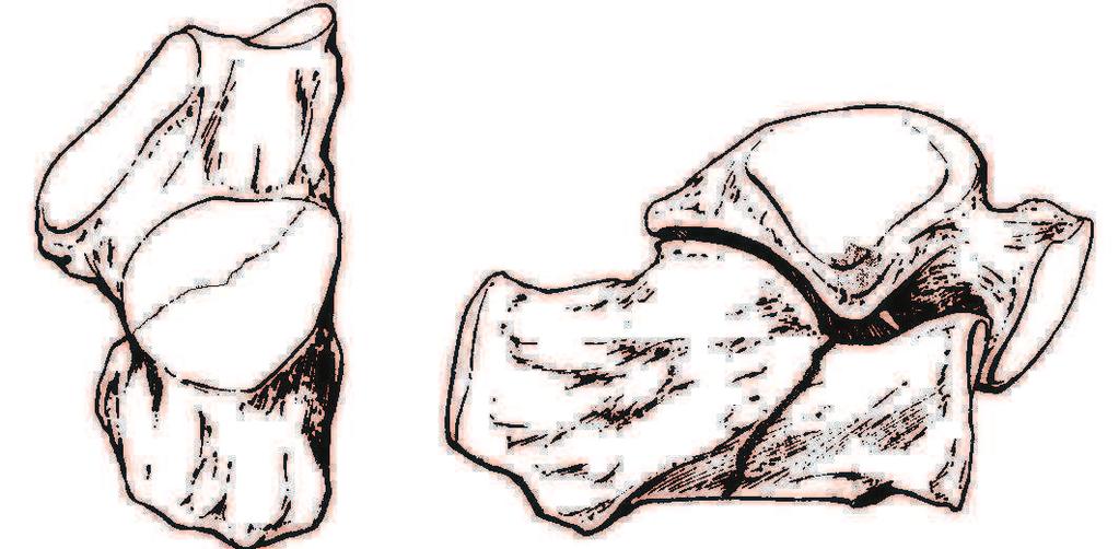 abtrennt. Es entsteht ein superomediales Fragment, das dem Sustentaculum entspricht und ein posterolaterales Fragment, das den Körper des Calcaneus darstellt (Abbildung 2).