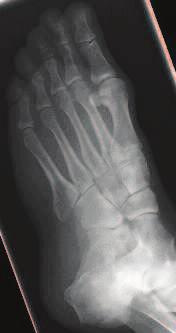 c) Abbildung 15: Röntgenaufnahmen des linken Calcaneus a) seitliche Aufnahme b) a.-p.-zielaufnahme c) Fuß Aufnahme 4.1.3.