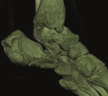 Abbildung 22: mediale Calcaneusfläche in 3D Ansicht Was insbesondere von unerfahreneren Ärzten besser bei 3D eingeschätzt wurde, war das Ausmaß der Höhenveränderung des Calcaneus.