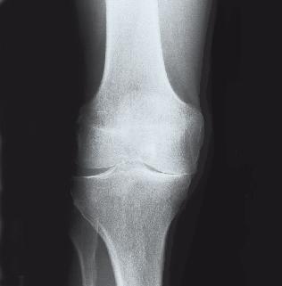 Nicht operative Behandlungsmethoden können zur Schmerzlinderung beitragen und eine Operation hinauszögern. Die Arthrose im Kniegelenk rückgängig machen können sie nicht.