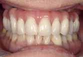 Stege können mit Extensionen versehen werden, welche so wie der gesamte Steg auch mit Kontakt dem Zahnfleischprofil folgen.