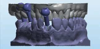 Zahnbogenscan mit abnehmbarem Weichgewebe. Nicht erforderlich für Fälle mit intraoralem Scannen (IO FLO). Eine (1) Gegenkiefer-Datei (Zahnbogen od.
