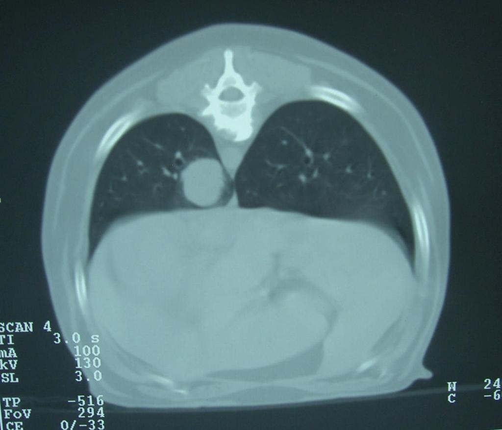 Abb. 27 : Tumor Lunge