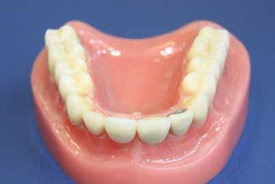Voll- Keramikkronen und -brücken Diese Kronen sehen den natürlichen Zähnen am ähnlichsten.
