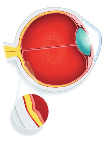 Was ist das Diabetische Makulaödem (DMÖ)? 6 7 Entstehung der Diabetischen Retinopathie und des Diabetischen Makulaödems Durch zu hohen Zuckerspiegel bilden sich schadhafte Blutgefäße im Auge.