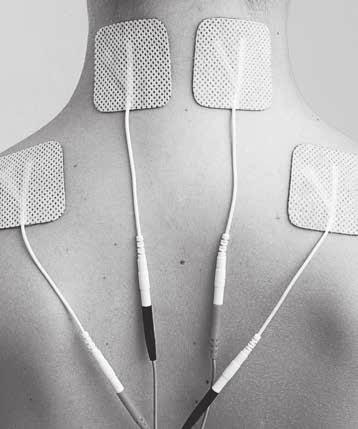 Die Elektrodenanlage erfolgt direkt auf oder in unmittelbarer Nähe des Schmerzgebietes, bzw. durch Einkreisen des Schmerzareals.