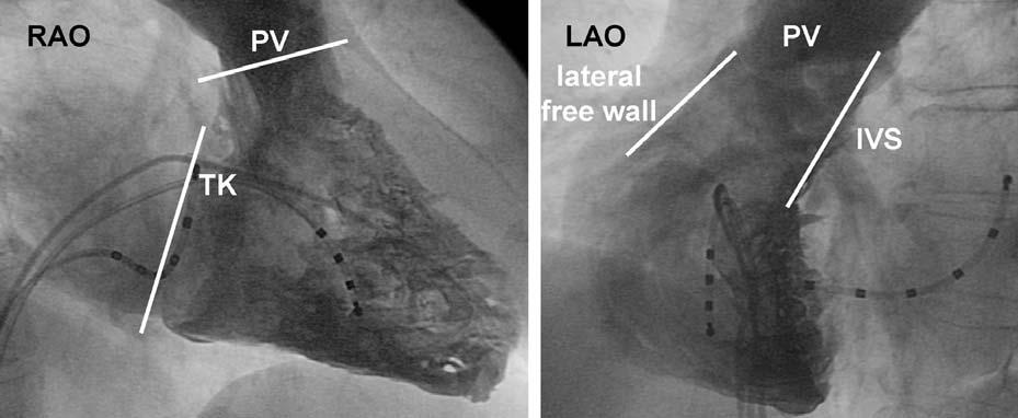 3.1 Idiopathische ventrikuläre Tachykardien Abb. 3.1 RV-Angiogramm in RAO- (links) und LAO-Projektionen (rechts).