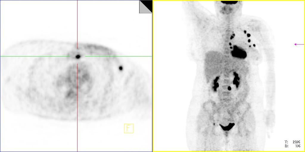 Staging FDG-PET/CT: Hals-Nasen-Ohren-Tumor Ind.