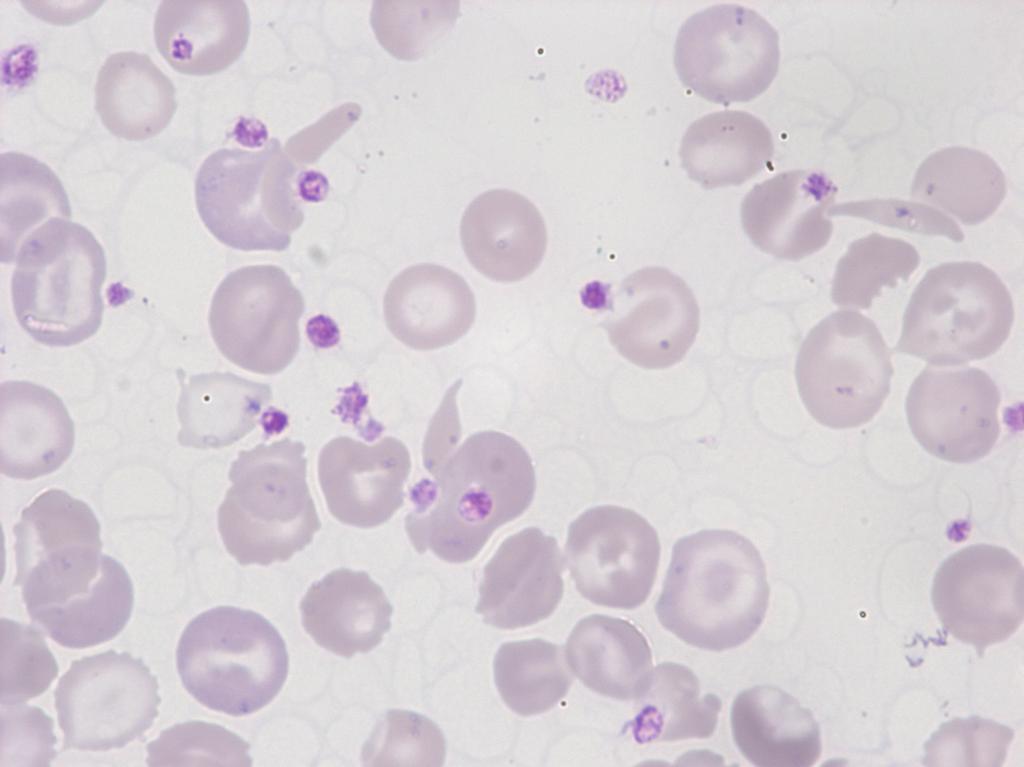 Bioanalytik Sichelzellanämie Erythroblast und Targetzellen