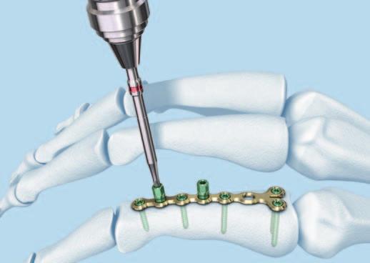 Implantation Den Schraubenziehereinsatz mit Haltehülse und den Handgriff mit Dentalkupplung verwenden, um die Schraube von Hand einzubringen.