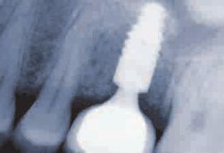 19 Das Implantat wächst fest im Kiefer ein. Vorteilhaft für die Einheilung: mikrostrukturierte Implantatoberflächen.