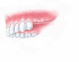 6 Als wäre nie etwas gewesen Implantate bei größeren Zahnlücken! Nebeneinander fehlen mehrere Zähne. Mit Zahnimplantaten lassen sich nicht einfach nur Lücken schließen.