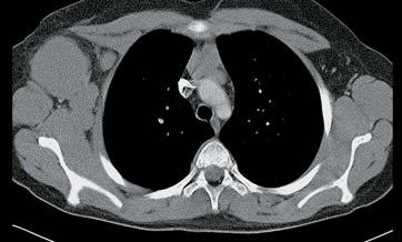 Abb. 5: 15jähriger Patient mit Hodgkin-Lymphom: Das CT zeigt einen großen Tumor in der rechten Achselhöhle, das PET zeigt eine deutlich erhöhte Stoffwechselaktivität in dieser Region, es ist