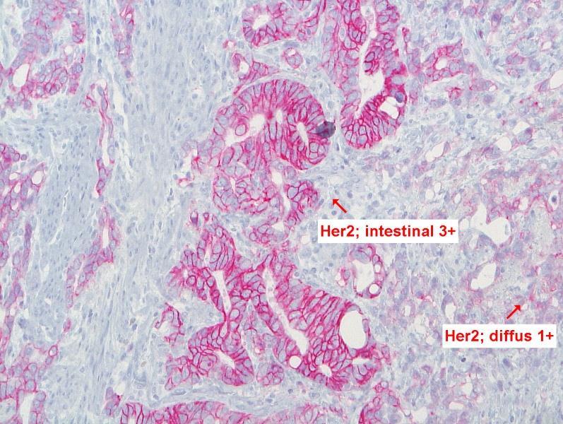 HER2-positives Magenkarzinom Überlebensvorteil Trastuzumab bei HER2-pos.