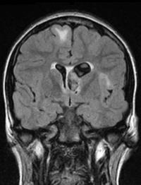 Fokus Neurologische Manifestationen bei TSC Mehr als 90% der Patienten mit TSC haben neurologische Manifestationen 1 Epileptische Anfälle sind die häufigsten neurologischen Erkrankungen bei TSC