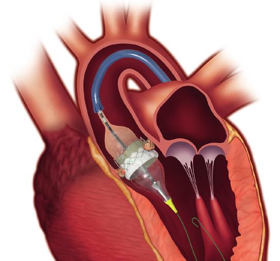 Liebe Kolleginnen und Kollegen, das 14. Lüdenscheider Kardiologie-Symposium steht diesmal unter dem Motto Kardiologie zwischen Innovationen und Limitationen.