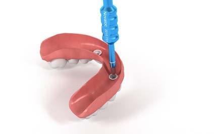 2.3 Vorgehen in der Zahnarztpraxis 2.3. Eingliederung der neuen Novaloc Deckprothese Schritt Entfernen des Novaloc Montageeinsatzes Verwenden Sie das Aushebeinstrument für Montageeinsätze (blau) und
