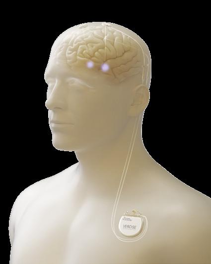 Die Elektroden werden an den Stimulator angeschlossen, der im Brustbereich unter der Haut platziert wird.