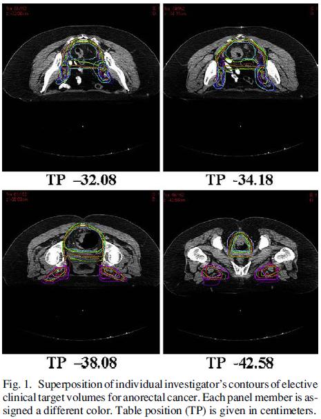 Variationen beim Analkarzinom MD Anderson Mayo Clinic Washington University Princess Margaret