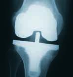 In der Regel werden die Teile des künstlichen Kniegelenkes mit einem speziellen Zement am Knochen fixiert.