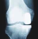 Man spricht dann von einer zementfreien Verankerung. Abhängig vom Grad der Zerstörung des Kniegelenkes wird Ihr Arzt entscheiden, ob ein Teilersatz (Schlitten - unicondyläre Prothese) (Abb.