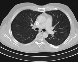 Low-Dose CT