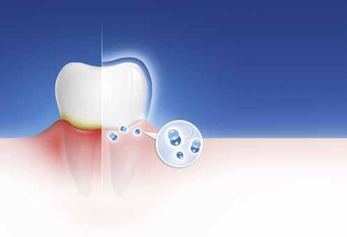 Fortgeschrittene Zahnfleischprobleme?