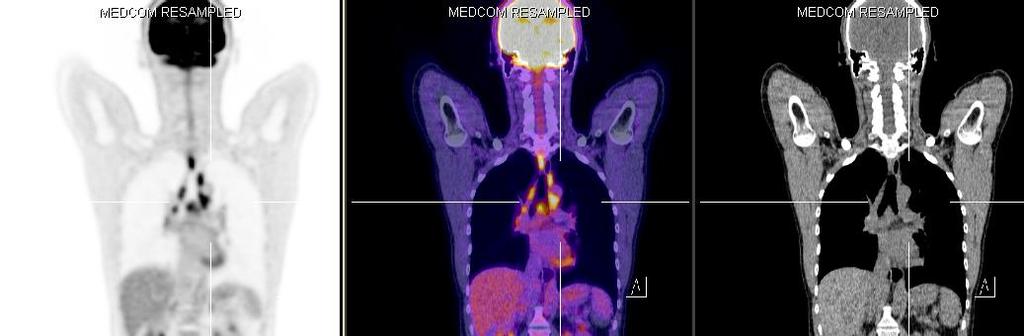 43-jähriger Patient mit Status nach malignem Melanom Wange links Anreichernde mediastinale LN entsprechen nachweislich einer Sarkoidose und