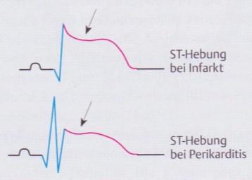 ST-Hebung bei akuter Perikarditis Bei einer akuten Perikarditis ist in den betroffenen Ableitungen der Abgang einer ST-Hebung aus dem aufsteigenden S-Schenkel zu sehen.