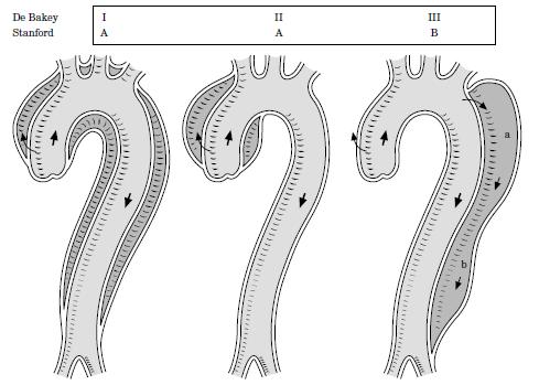 Einleitung Bei den Aortopathien stellen die bi- und unicuspiden Aortenklappen mit einer oft konsekutiven Dilatation im annuloaortalen Bereich, Aortenaneurysmen sowie Aortenisthmusstenosen