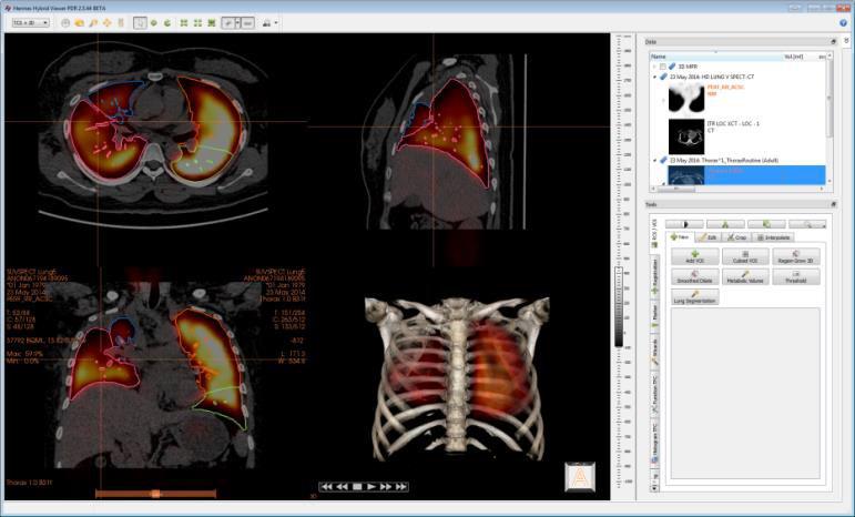 SUV SPECT Perfusion Quantification Initial / Pre-surgery 23 April