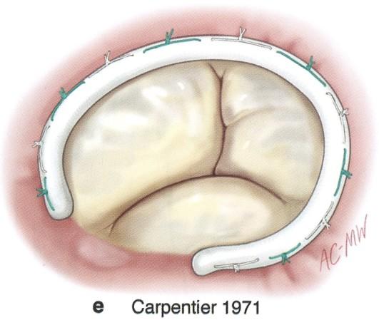 Abbildung 8: Physiologischer Carpentierring an der Trikuspidalklappe [38] 2.11.4.