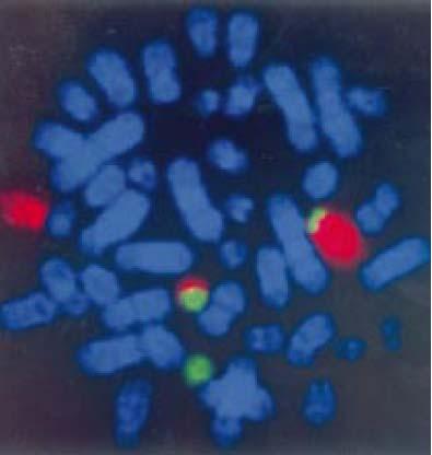TEL/AML1-Translokation Translokation Chromosom 12 (AML1-Gen) Chromosom 21