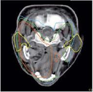 älteren 2D-Techniken signifikant überlegen, so dass insbesondere die D mean -Parotis kontralateral mit 32,6 Gy unterhalb der angenommenen TD50 von 37 Gy lag, Abb.