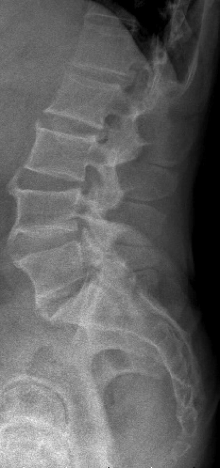 Kurzbeschreibung: Dies ist ein Röntgenbild einer LWS mit osteochondrotischen Veränderungen mit teils durchgehenden Anbauten im Bereich L3-S1, sowie
