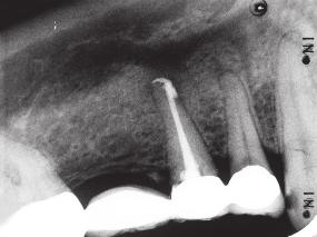 2: Unmittelbar nach Wurzelfüllung im September 2005 ist die Aufhellung weitgehend ausgeheilt. Am Zahn 44 hat sich zwischenzeitlich ebenfalls eine apikale Ostitis ausgebildet. Abb.