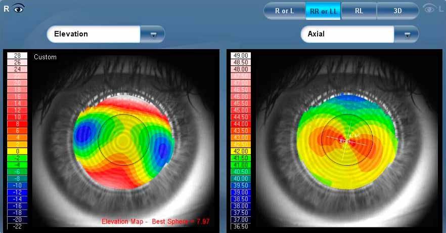 niedriger und höherer Ordnung mittels Sehschärfensimulation Pachymetrie und Vorderkammer-Analyse mit