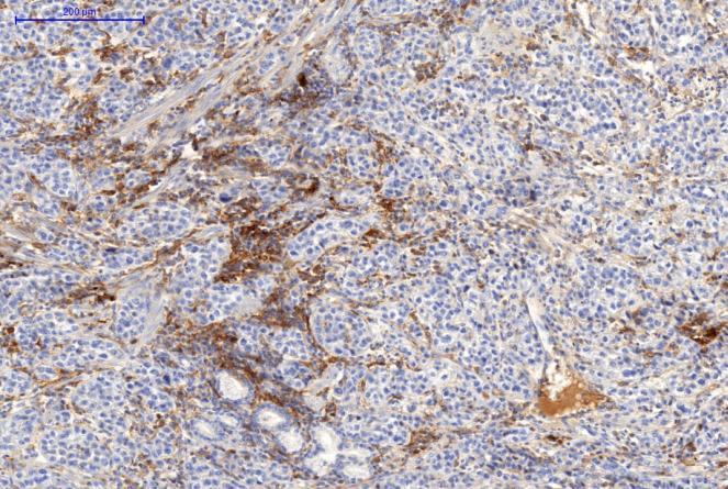 A 100x Nur 1/13 Tumor hatte eine membranöse geringfügige PD-L1-Expression in Tumorzellen.