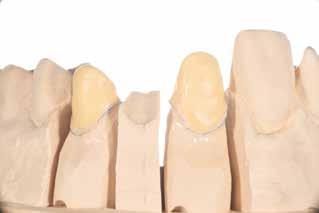 (Wenn der Kern in einem bestimmten Bereich unterhalb der empfohlenen Mindeststärke für das Gerüst liegt, darf keine Dentinmasse aufgetragen werden.
