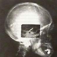Einsatz des ersten Cochlea-Implantates im Menschen Charles Eyriès