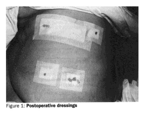 Verblindung-Beispiel "Identical opaque dressings (figure 1) were used irrespective of which operation was done.