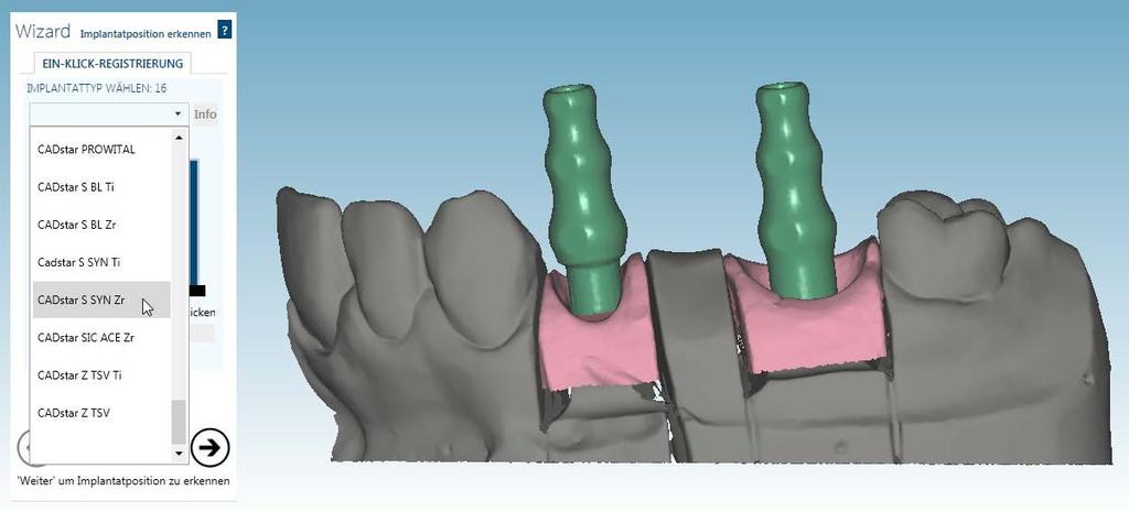 4.0 Abutments konstruieren 4.1 Implantatposition erkennen Wurde die Ausrichtung der Implantate nicht bereits in Punkt 3.