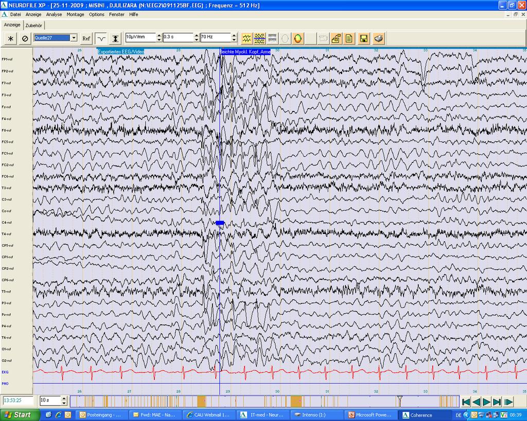 EINLEITUNG A) B) Abbildung 1 Irreguläre generalisierte spike-waves und polyspike-waves im Wach(A)- und Schlaf(B)-EEG bei einer Patientin mit MAE Therapie: Die medikamentöse Therapie der MAE gestaltet