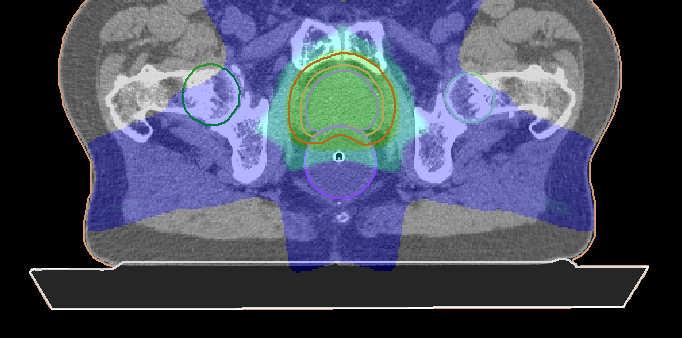 Prostatakarzinom Photonen IMRT