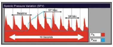 Einleitung Abnahme des SYS AP (SPV delta down), verursacht durch eine Verminderung des SV, folgt eine Zunahme des SYS AP (SPV delta up), hervorgerufen durch eine Zunahme des SV.