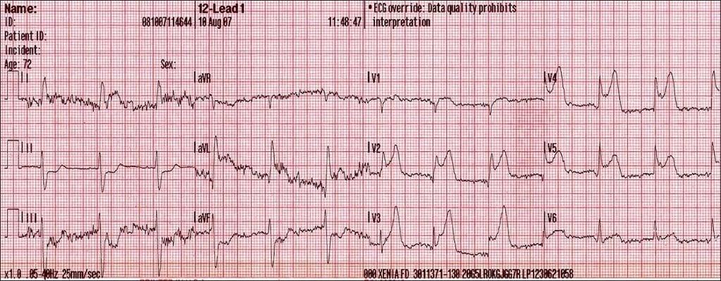 Akutes Koronar-Syndrom (ACS)* ST-Hebungs Myokardinfarkt (STEMI)