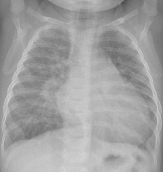 Thorax-Rx: Kardiomegalie und