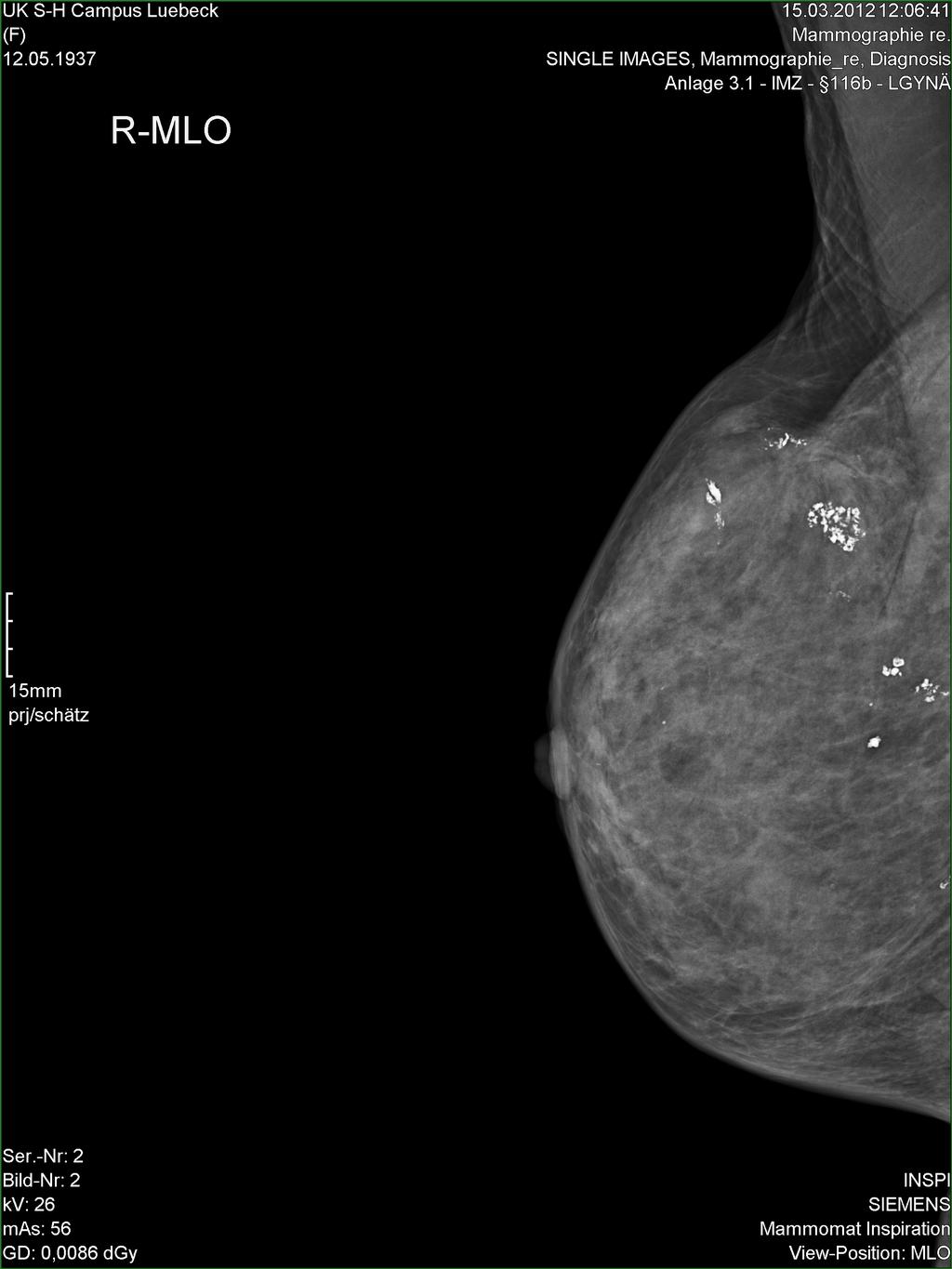 10 Abbildung 2 Mammographieaufnahme (mediolateral-oblique)